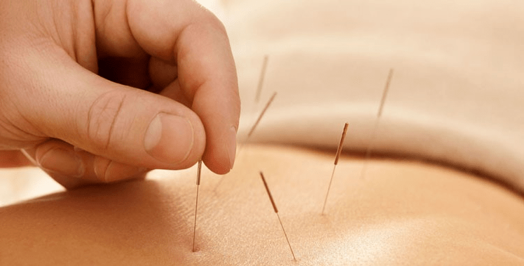 Akupunktur géint Fëmmen